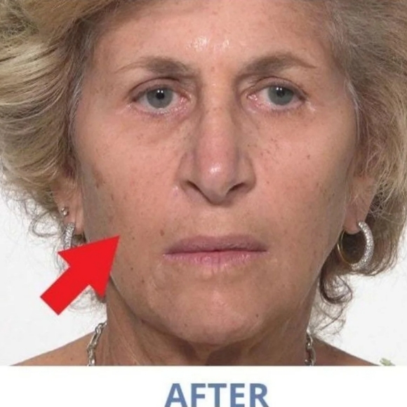 Plexaderm Rapid Reduction Serum Advanced Formula TVs best seller for fine lines - Picture 6 of 8
